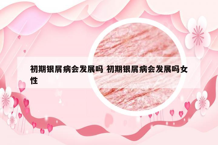 初期银屑病会发展吗 初期银屑病会发展吗女性