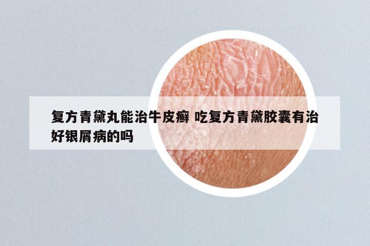 复方青黛丸能治牛皮癣 吃复方青黛胶囊有治好银屑病的吗