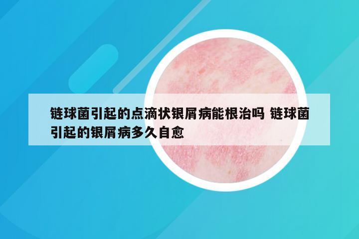 链球菌引起的点滴状银屑病能根治吗 链球菌引起的银屑病多久自愈