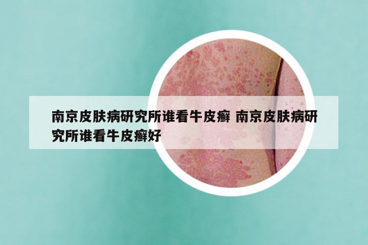 南京皮肤病研究所谁看牛皮癣 南京皮肤病研究所谁看牛皮癣好