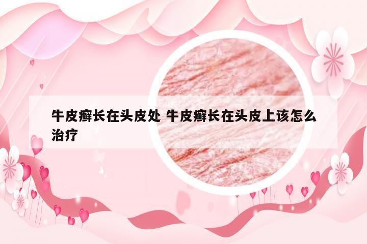 牛皮癣长在头皮处 牛皮癣长在头皮上该怎么治疗