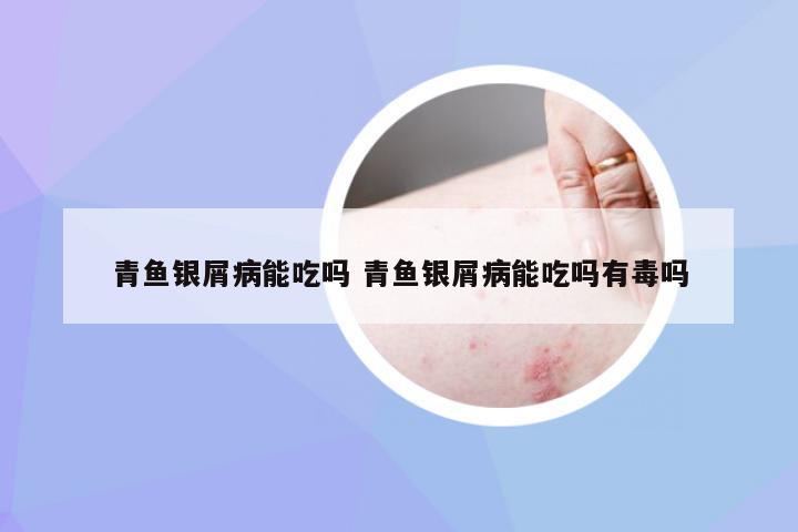 青鱼银屑病能吃吗 青鱼银屑病能吃吗有毒吗