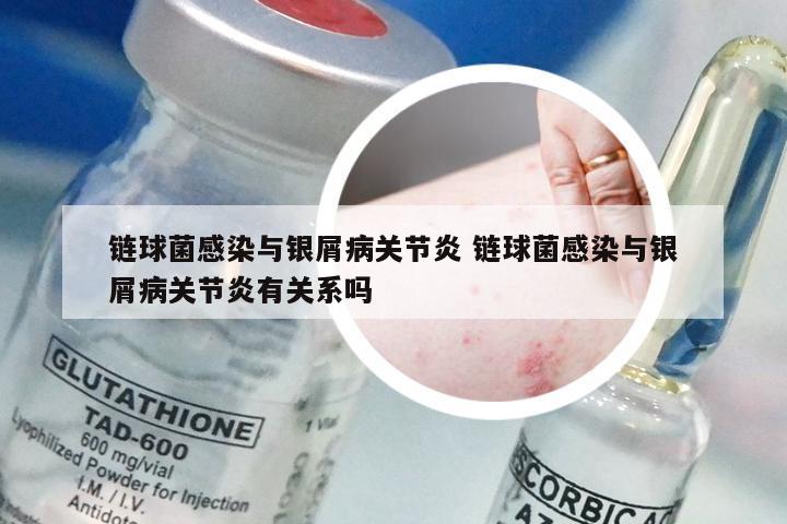 链球菌感染与银屑病关节炎 链球菌感染与银屑病关节炎有关系吗
