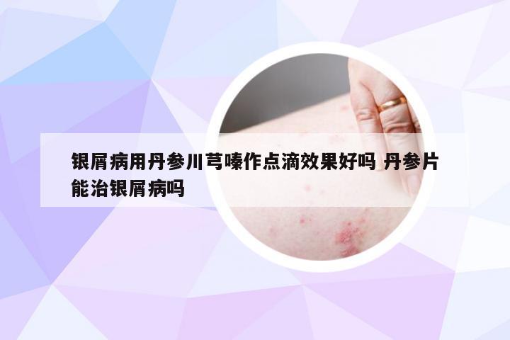 银屑病用丹参川芎嗪作点滴效果好吗 丹参片能治银屑病吗