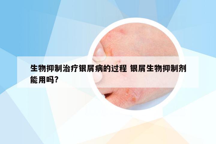 生物抑制治疗银屑病的过程 银屑生物抑制剂能用吗?