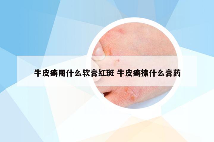 牛皮癣用什么软膏红斑 牛皮癣擦什么膏药