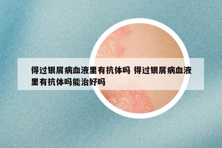 得过银屑病血液里有抗体吗 得过银屑病血液里有抗体吗能治好吗