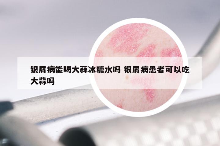 银屑病能喝大蒜冰糖水吗 银屑病患者可以吃大蒜吗