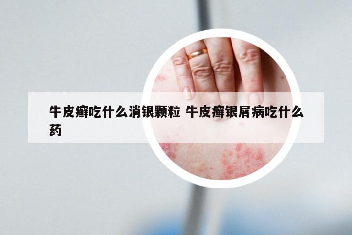牛皮癣吃什么消银颗粒 牛皮癣银屑病吃什么药