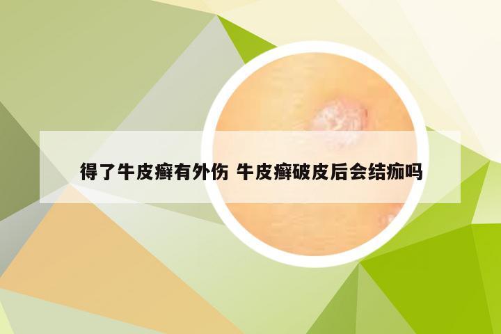 得了牛皮癣有外伤 牛皮癣破皮后会结痂吗