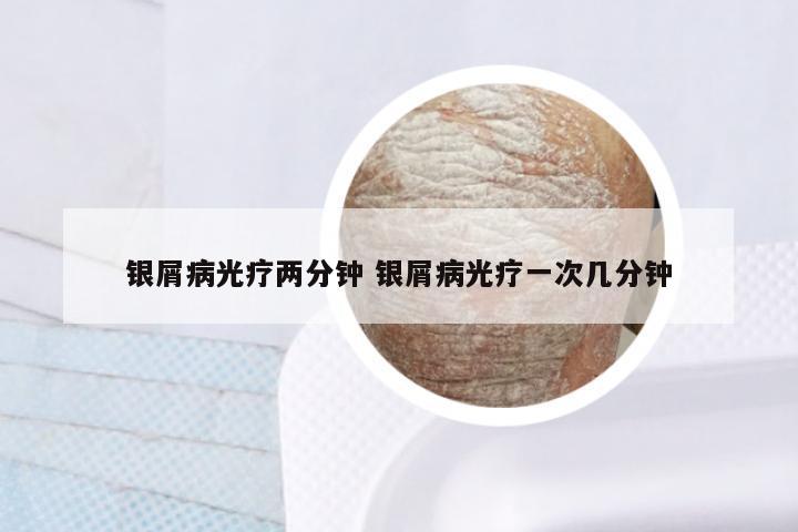 银屑病光疗两分钟 银屑病光疗一次几分钟