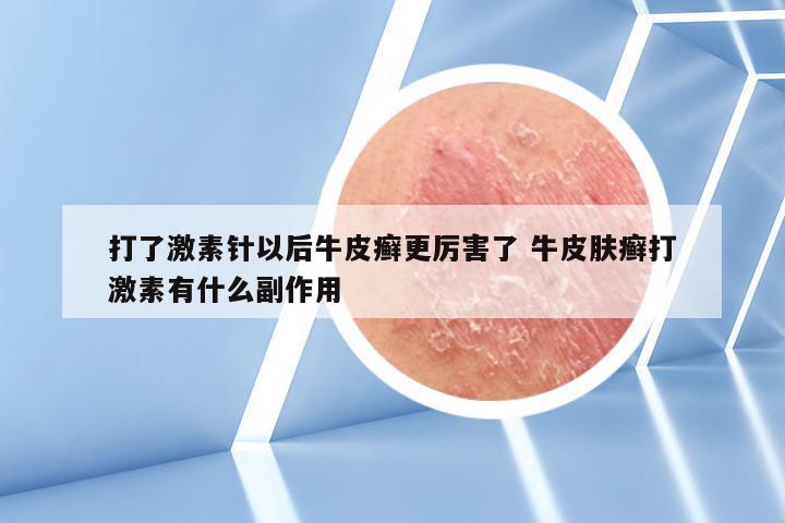 打了激素针以后牛皮癣更厉害了 牛皮肤癣打激素有什么副作用