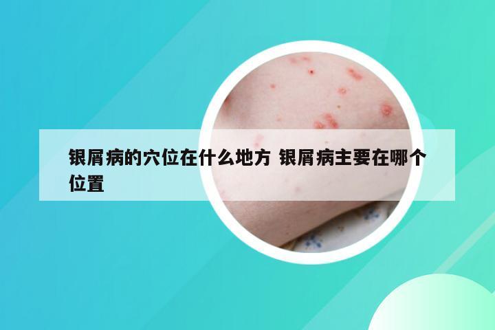 银屑病的穴位在什么地方 银屑病主要在哪个位置