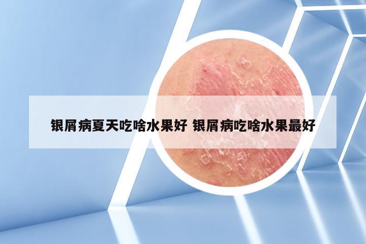 银屑病夏天吃啥水果好 银屑病吃啥水果最好