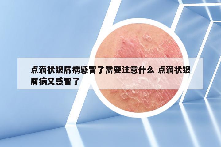 点滴状银屑病感冒了需要注意什么 点滴状银屑病又感冒了