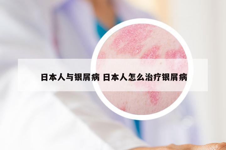 日本人与银屑病 日本人怎么治疗银屑病