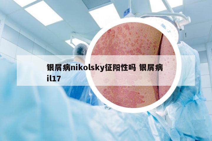 银屑病nikolsky征阳性吗 银屑病 il17