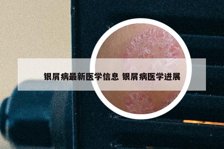 银屑病最新医学信息 银屑病医学进展