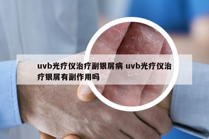 uvb光疗仪治疗副银屑病 uvb光疗仪治疗银屑有副作用吗