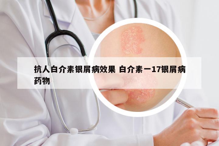 抗人白介素银屑病效果 白介素一17银屑病药物