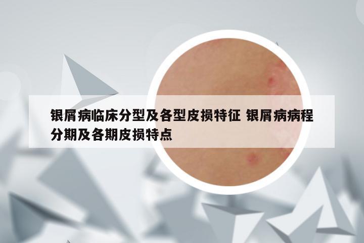 银屑病临床分型及各型皮损特征 银屑病病程分期及各期皮损特点