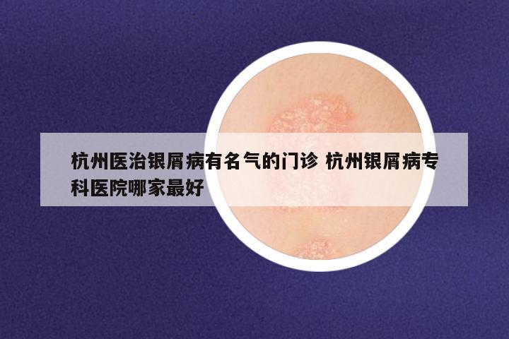 杭州医治银屑病有名气的门诊 杭州银屑病专科医院哪家最好