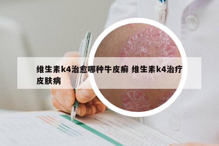 维生素k4治愈哪种牛皮癣 维生素k4治疗皮肤病