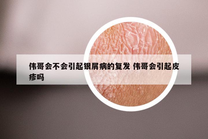 伟哥会不会引起银屑病的复发 伟哥会引起皮疹吗