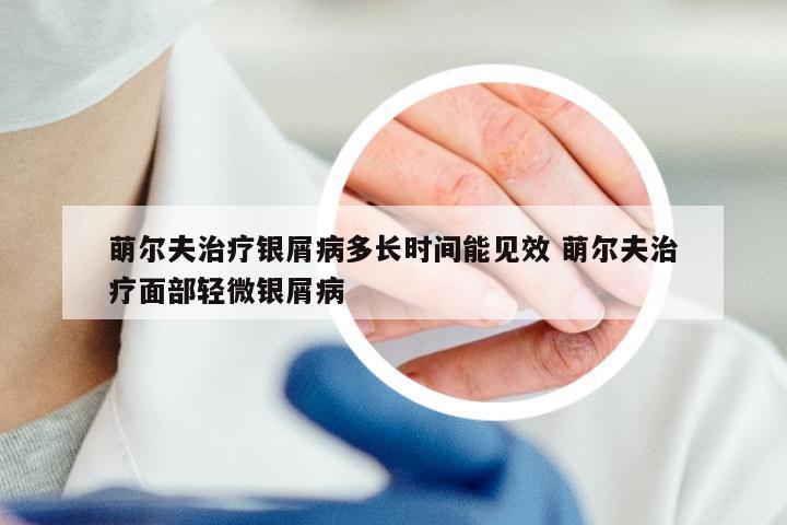 萌尔夫治疗银屑病多长时间能见效 萌尔夫治疗面部轻微银屑病