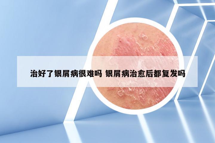 治好了银屑病很难吗 银屑病治愈后都复发吗