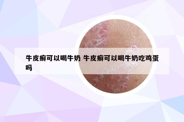 牛皮癣可以喝牛奶 牛皮癣可以喝牛奶吃鸡蛋吗