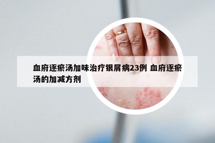 血府逐瘀汤加味治疗银屑病23例 血府逐瘀汤的加减方剂