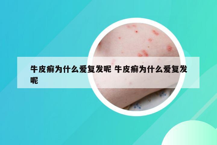 牛皮癣为什么爱复发呢 牛皮癣为什么爱复发呢