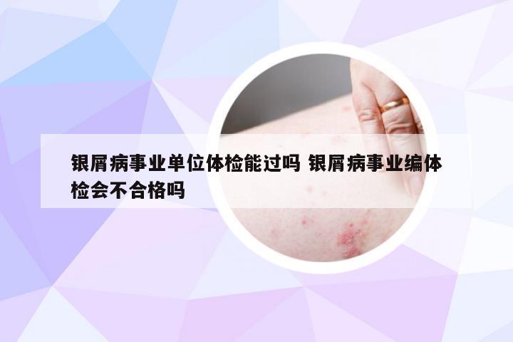 银屑病事业单位体检能过吗 银屑病事业编体检会不合格吗
