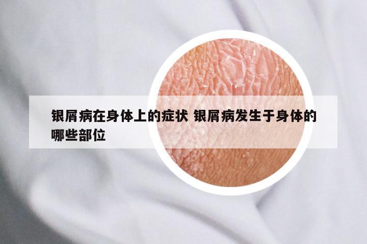银屑病在身体上的症状 银屑病发生于身体的哪些部位
