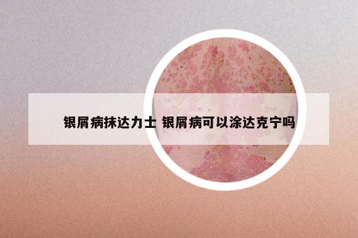 银屑病抹达力士 银屑病可以涂达克宁吗