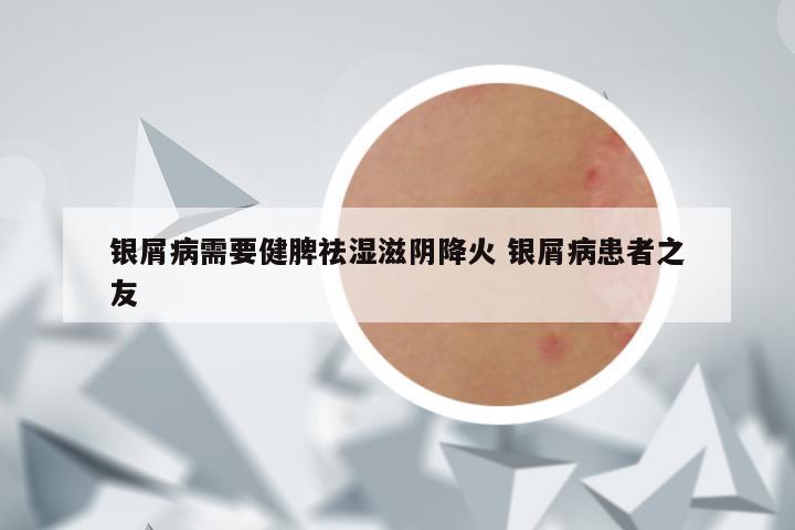 银屑病需要健脾祛湿滋阴降火 银屑病患者之友