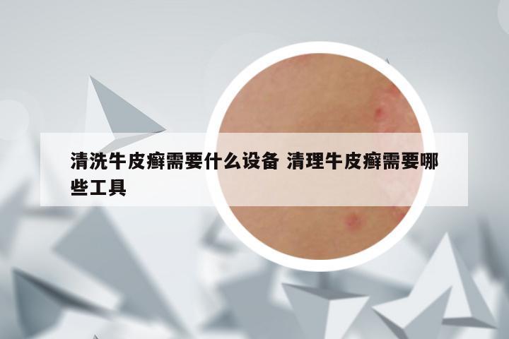 清洗牛皮癣需要什么设备 清理牛皮癣需要哪些工具