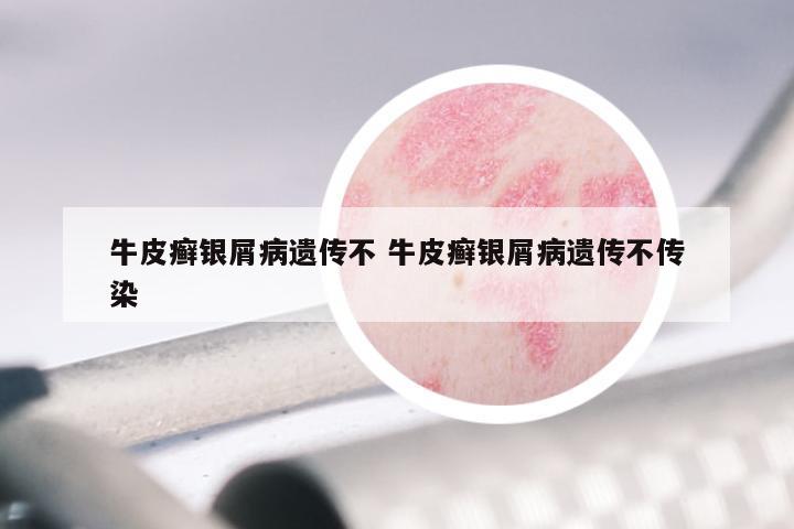 牛皮癣银屑病遗传不 牛皮癣银屑病遗传不传染