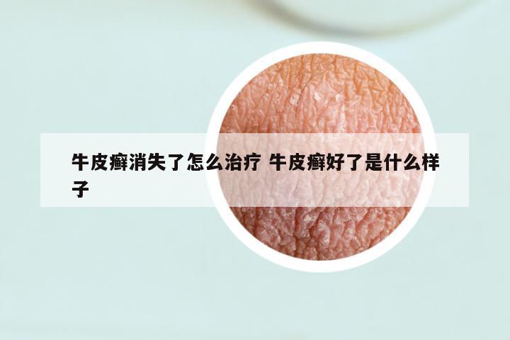 牛皮癣消失了怎么治疗 牛皮癣好了是什么样子
