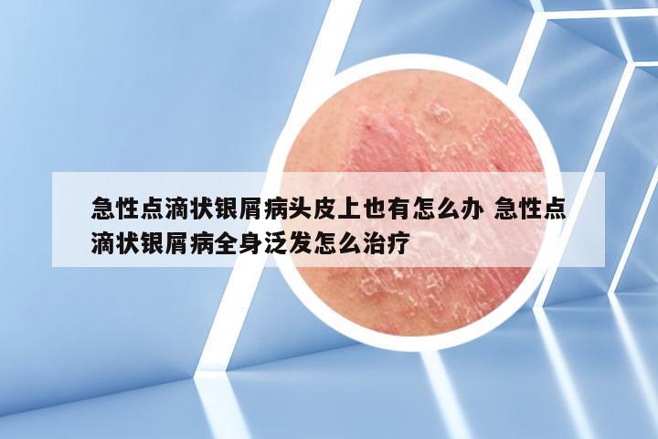 急性点滴状银屑病头皮上也有怎么办 急性点滴状银屑病全身泛发怎么治疗