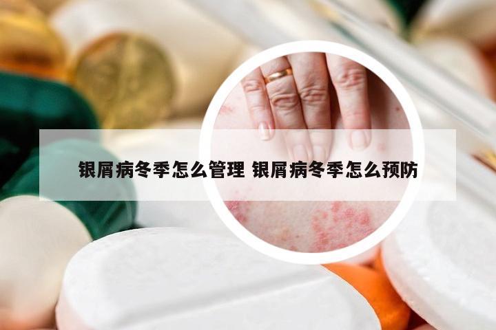 银屑病冬季怎么管理 银屑病冬季怎么预防