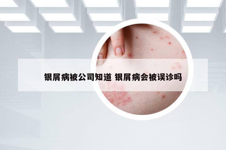 银屑病被公司知道 银屑病会被误诊吗