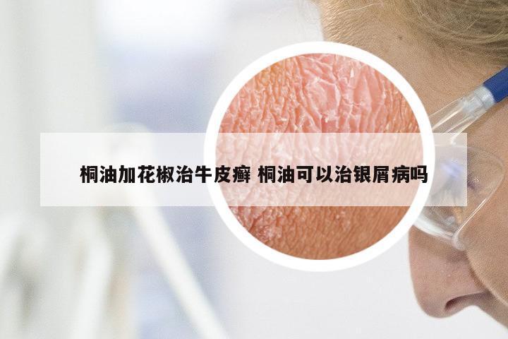 桐油加花椒治牛皮癣 桐油可以治银屑病吗