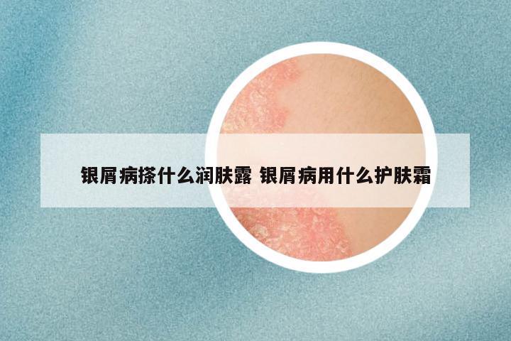 银屑病搽什么润肤露 银屑病用什么护肤霜