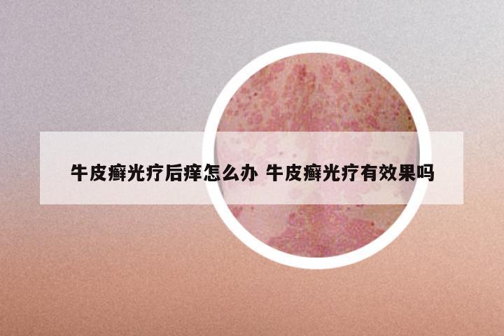 牛皮癣光疗后痒怎么办 牛皮癣光疗有效果吗