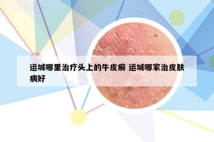 运城哪里治疗头上的牛皮癣 运城哪家治皮肤病好