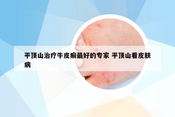平顶山治疗牛皮癣最好的专家 平顶山看皮肤病