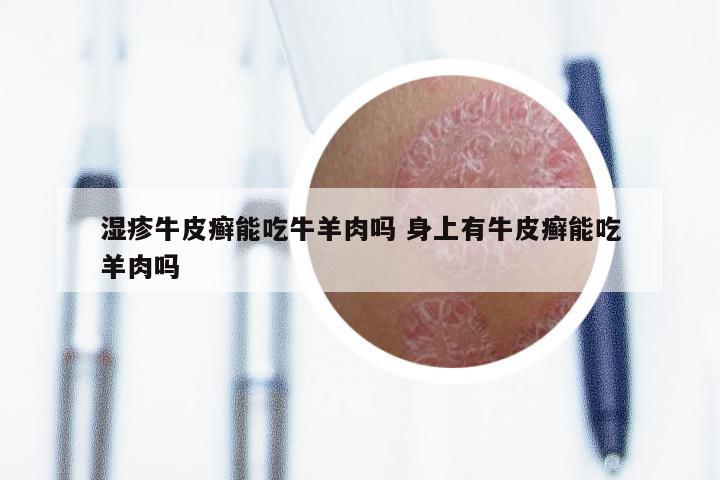 湿疹牛皮癣能吃牛羊肉吗 身上有牛皮癣能吃羊肉吗