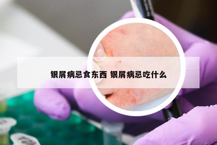 银屑病忌食东西 银屑病忌吃什么